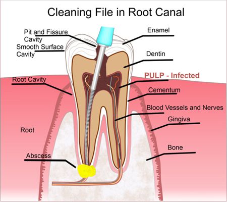  Illustration of Tooth of Infected Pulp and Cleaning File