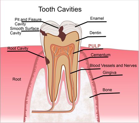Tooth Illustration with Cavities 