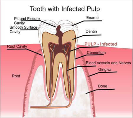 Tooth with Infected Pulp